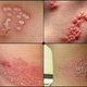Illustration for article titled cara menghilangkan rasa sakit herpes zosterem/em